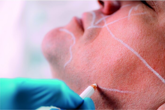 CAUSES OF FROWN LINES