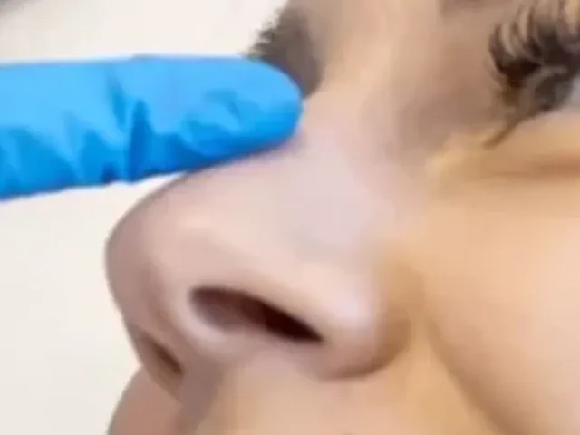 HOW LONG DOES BOTOX LAST?