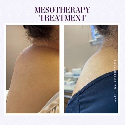 Mesotherapy to melt away back hump.jpg
