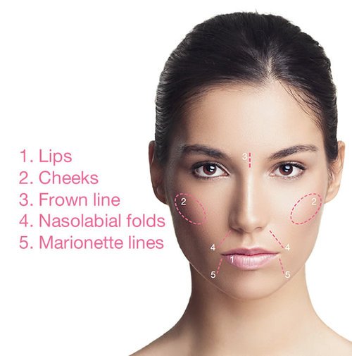 dermal-filler-treatment-areas.jpg