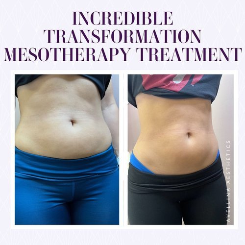 non-surgica liposuctionl.jpg