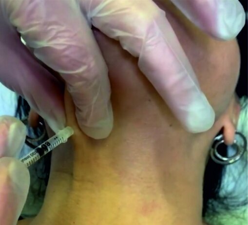 BOTOX IN PHILADELPHIA : SMOOTH AWAY WRINKLES FOR YOUTHFUL SKIN