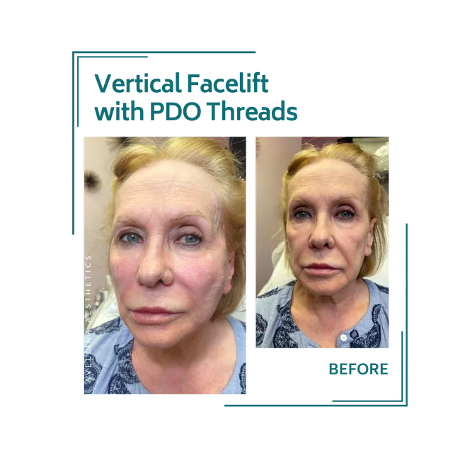 PDO threads_14avellinaaesthetics