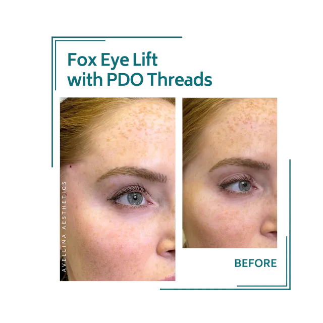 PDO threads_15avellinaaesthetics