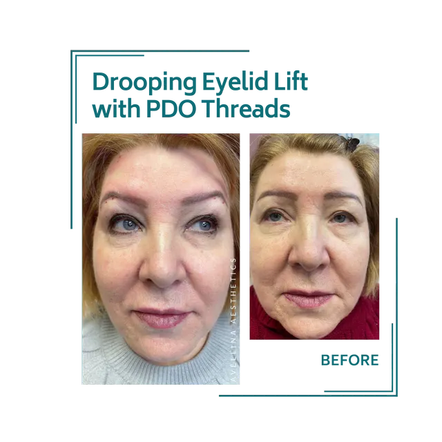 PDO threads_16avellinaaesthetics