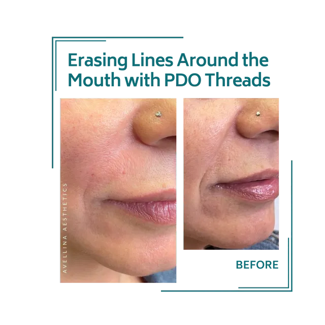 PDO threads_18avellinaaesthetics