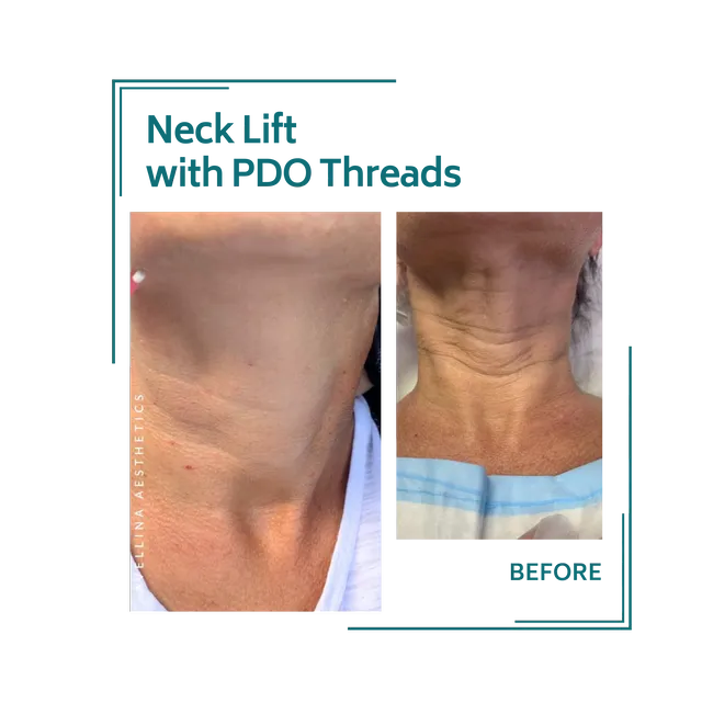 PDO threads_19avellinaaesthetics