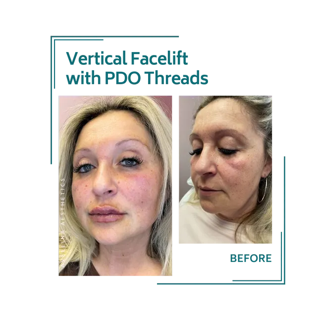 PDO threads_20avellinaaesthetics