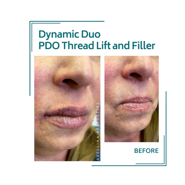 PDO threads_22avellinaaesthetics