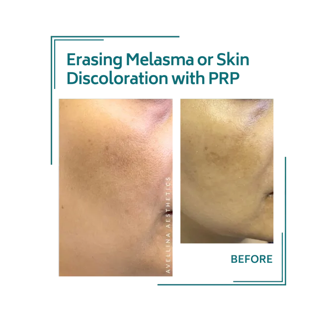 PRP_28avellinaaesthetics