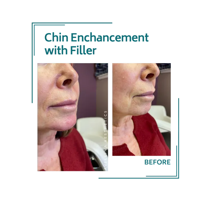 fillers_2avellinaaesthetics