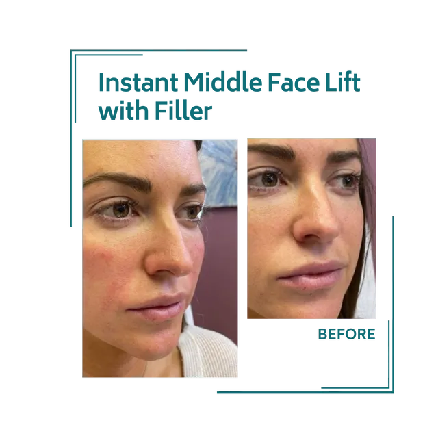 fillers_3avellinaaesthetics