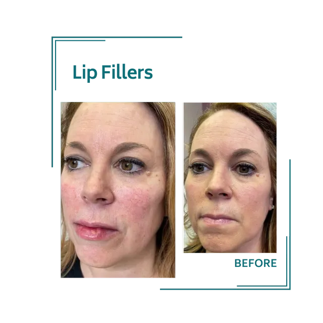 fillers_5avellinaaesthetics