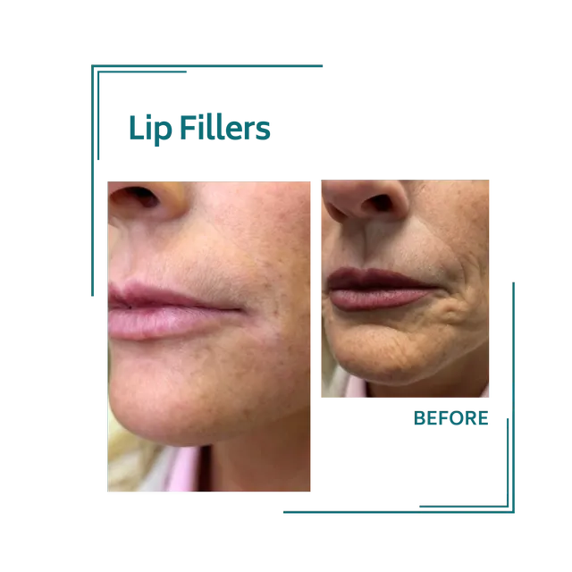 fillers_7avellinaaesthetics