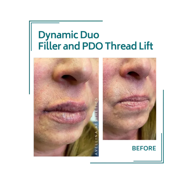 fillers_8avellinaaesthetics