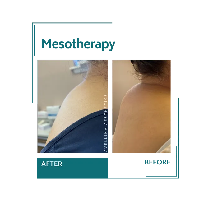 mesotherapy_10avellinaaesthetics