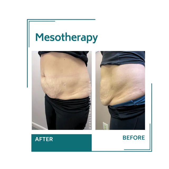 mesotherapy_11avellinaaesthetics