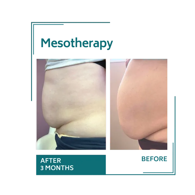 mesotherapy_13avellinaaesthetics