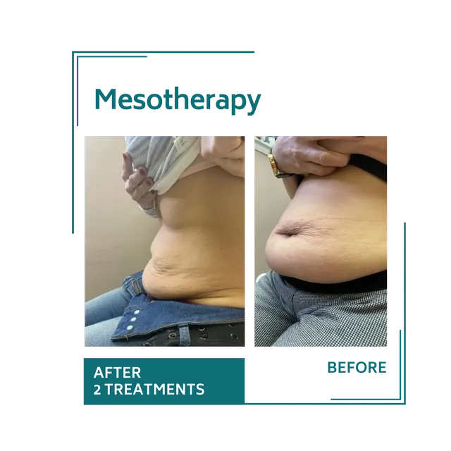 mesotherapy_9avellinaaesthetics
