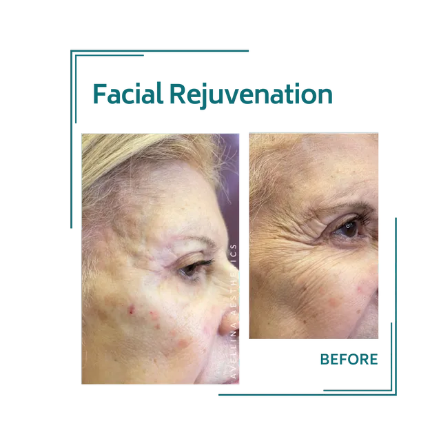 redjuvenation_23avellinaaesthetics