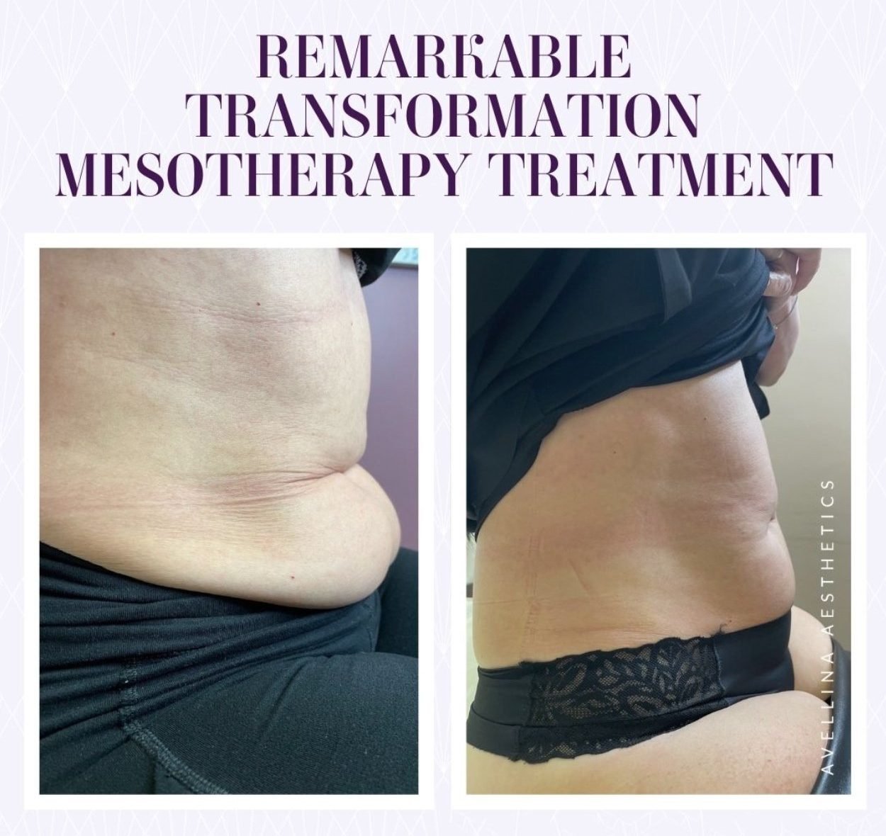 Mesotherapy used to melt stubborn belly fat